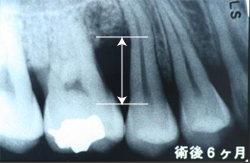 歯周病