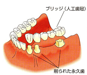 インプラント