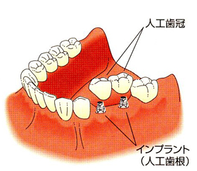 インプラント