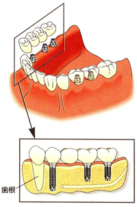 インプラント