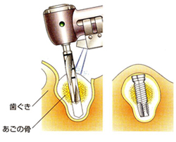 インプラント